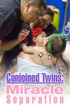 poster for Conjoined Twins: Miracle Separation